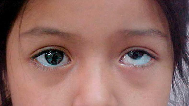 Амблиопия и ее лечение