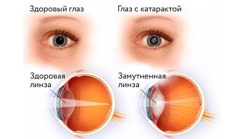 Мифы о катаракте