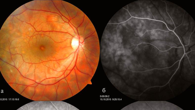 Лікування відшарування сітківки